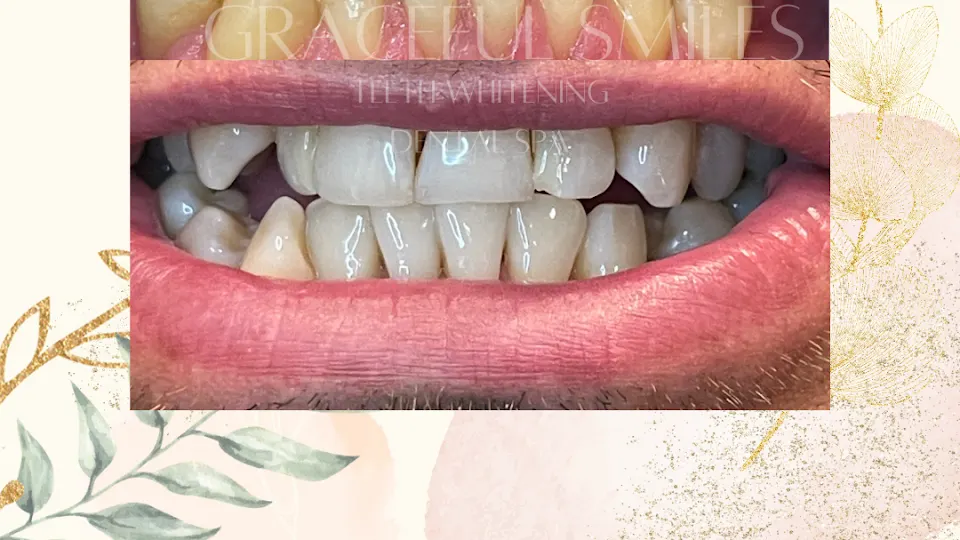 Graceful Smiles Dental Spa - Teeth whitening service in Beaufort, SC