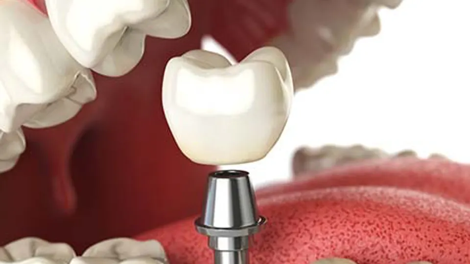 Holladay Hills Dental - Dentist in Salt Lake City, UT