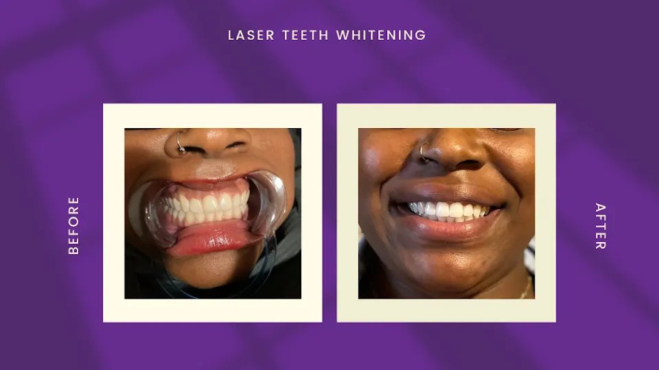 Royal Bright Smiles - Teeth whitening service in Little Rock, AR